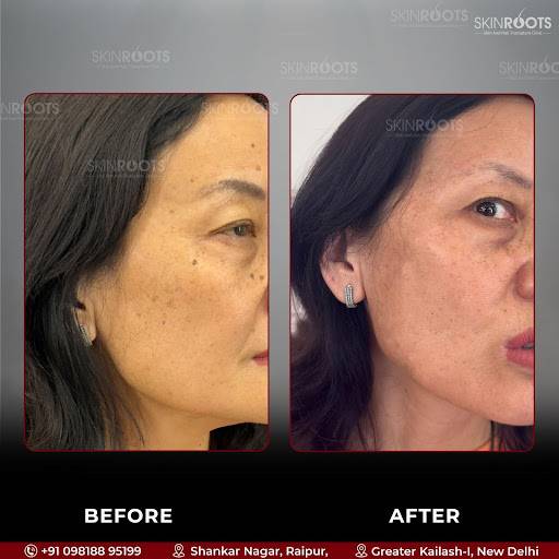 Mole Removal Treatment