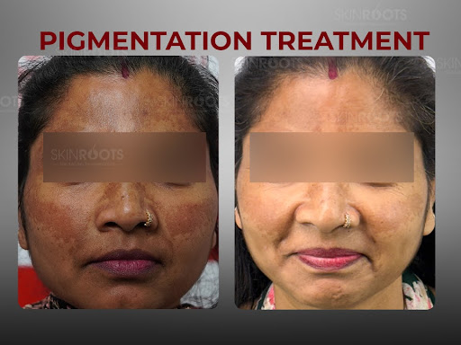 Pigmentation Treatment