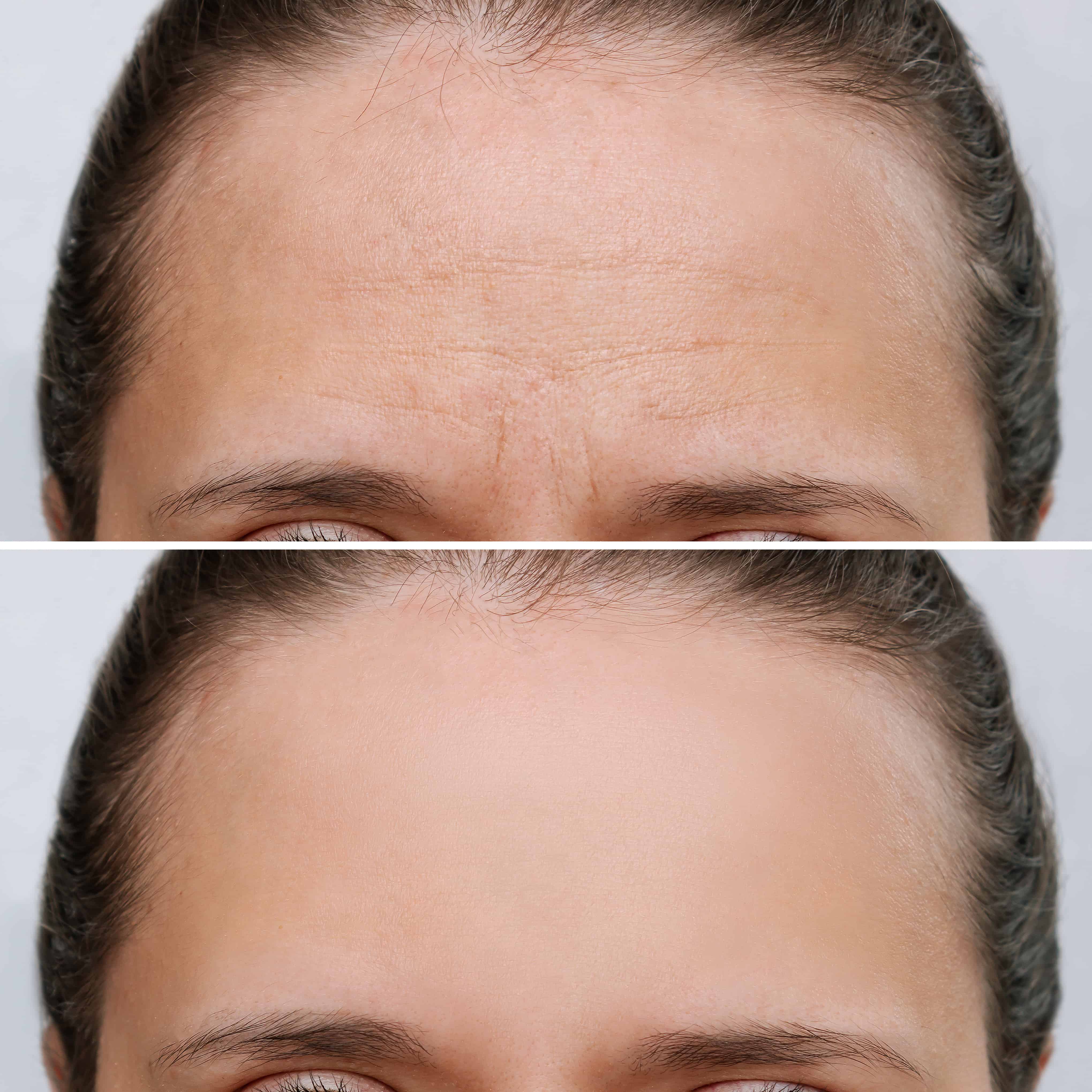 Botox is the Best Anti-Wrinkle Treatment