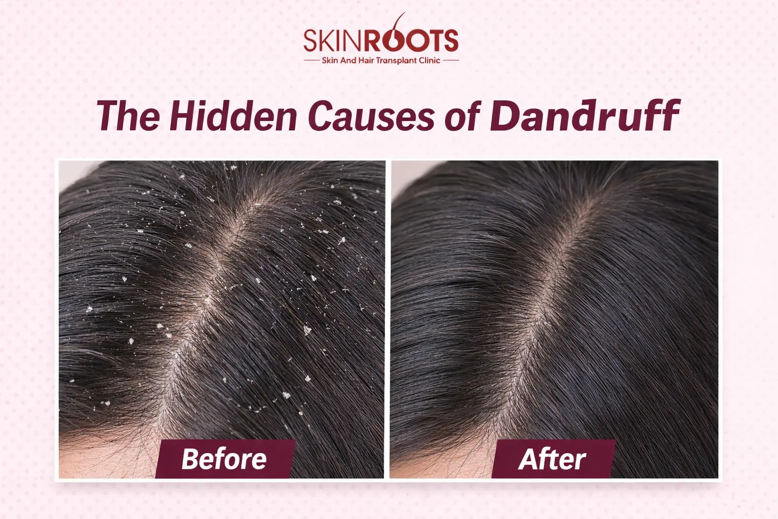The Hidden Causes of Dandruff Most People Ignore