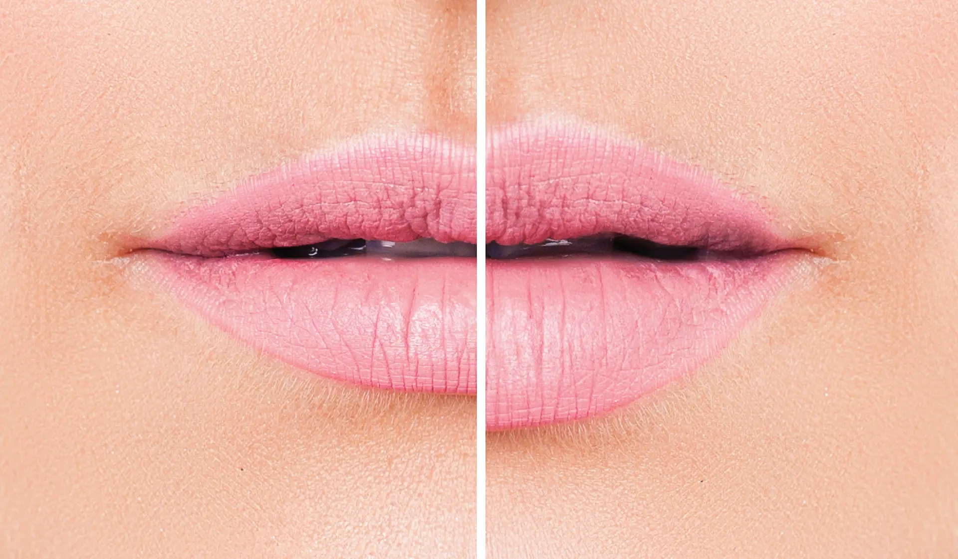 Major Reasons to Consider Lip Fillers In Delhi
