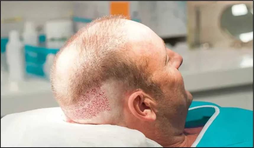 Do’s and Don’ts After a Hair Transplant Surgery