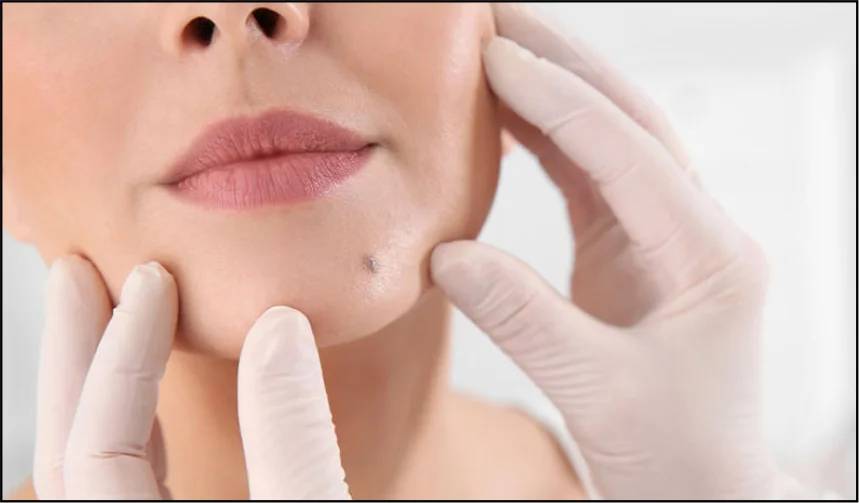 Everything You Need to Know About Mole Removal Treatment