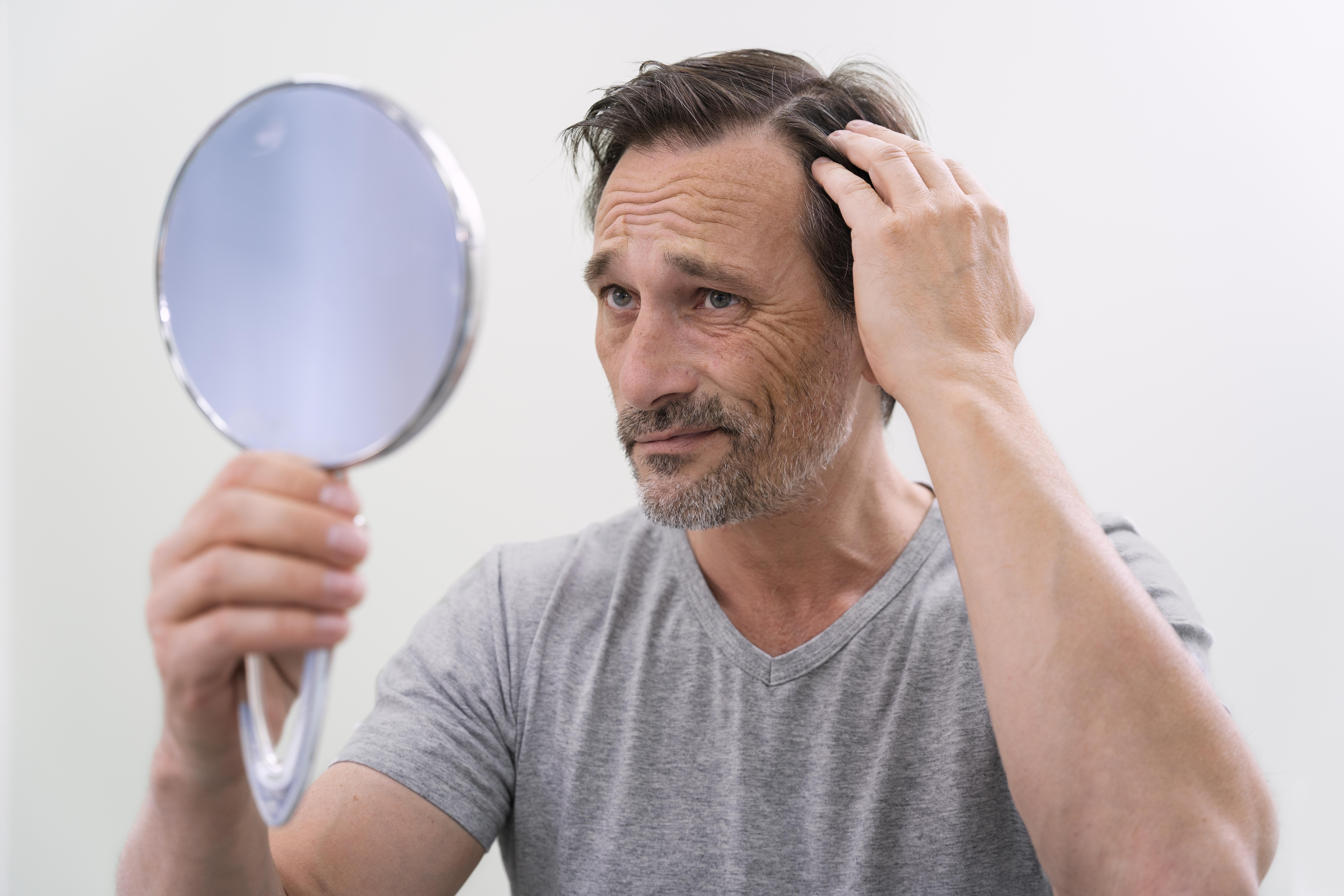 Oral minoxidil in male pattern hair loss.