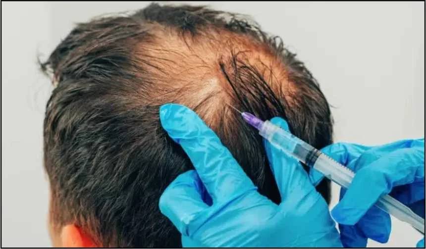 Why and When Should You Get PRP Injections After a Hair Transplant?