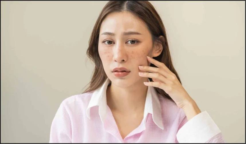 Top Dermatologist-Recommended Treatments for Melasma