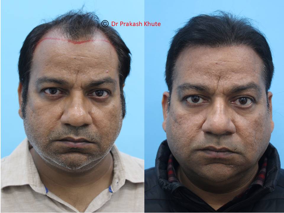 4200 graft hair transplant DHT by Eugenix India - Review - RealSelf
