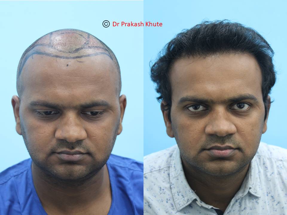 Share more than 69 eugenix hair transplant cost super hot - in.eteachers